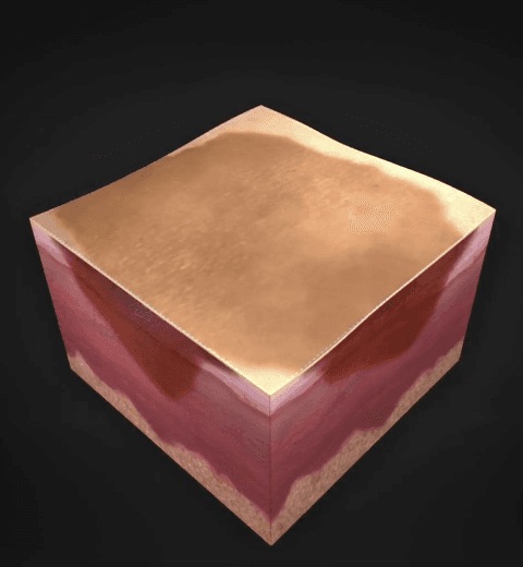 755nm Alexandrite Laser